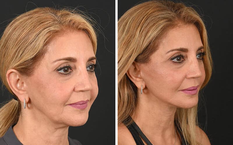 Deep plane facelift before and after