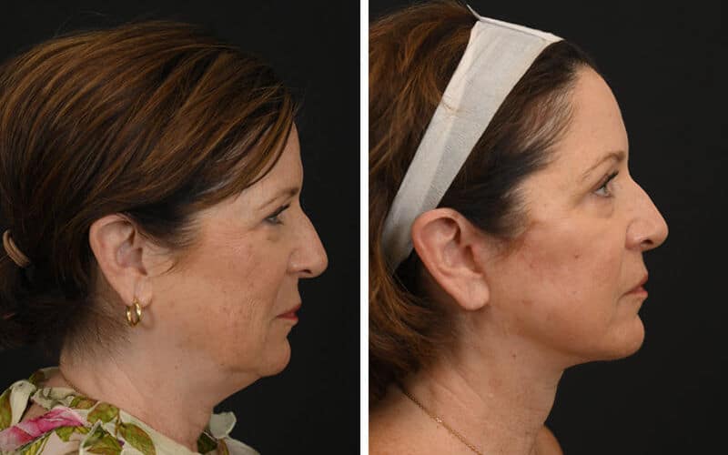 Deep plane facelift before and after