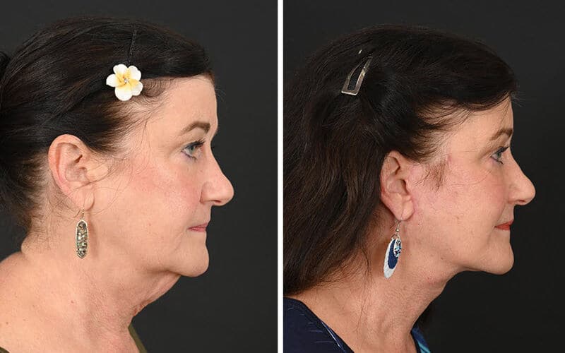 Deep plane facelift before and after