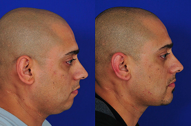 Chin surgery before and after example 3