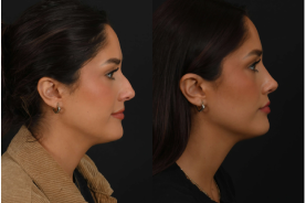 Ethnic rhinoplasty before and after example