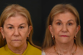 Eyelid surgery before and after example 1