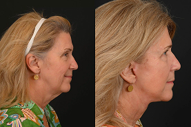 Face and neck lift before and after example 1