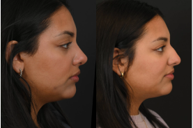 Preservation rhinoplasty before and after example