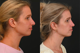 Revision rhinoplasty before and after example