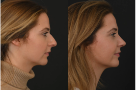 Rhinoplasty before and after example
