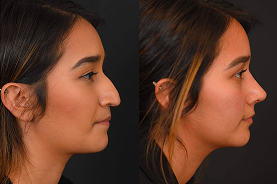 Teen rhinoplasty before and after example