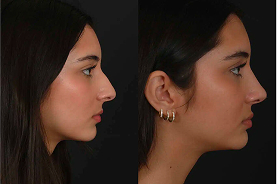 Ultrasonic rhinoplasty before and after example