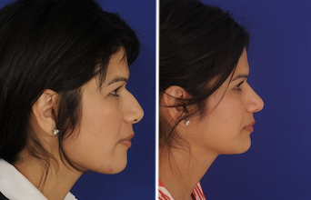 Ethnic Rhinoplasty 2