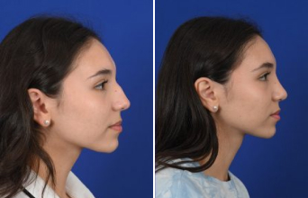 Female Rhinoplasty 3