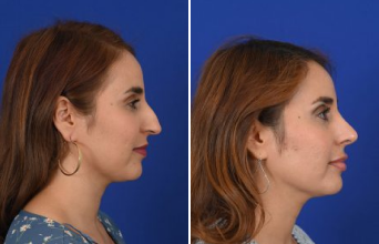 Female Rhinoplasty 2