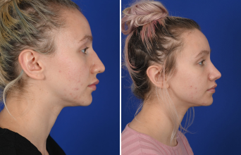 Female Rhinoplasty 1