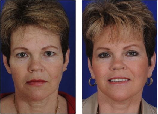 Eyelid Surgery