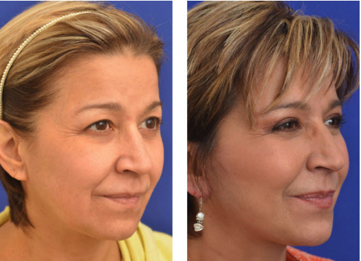 Eyelid Surgery