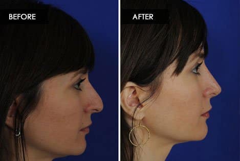 Rhinoplasty vs. Septoplasty: Explaining the Difference