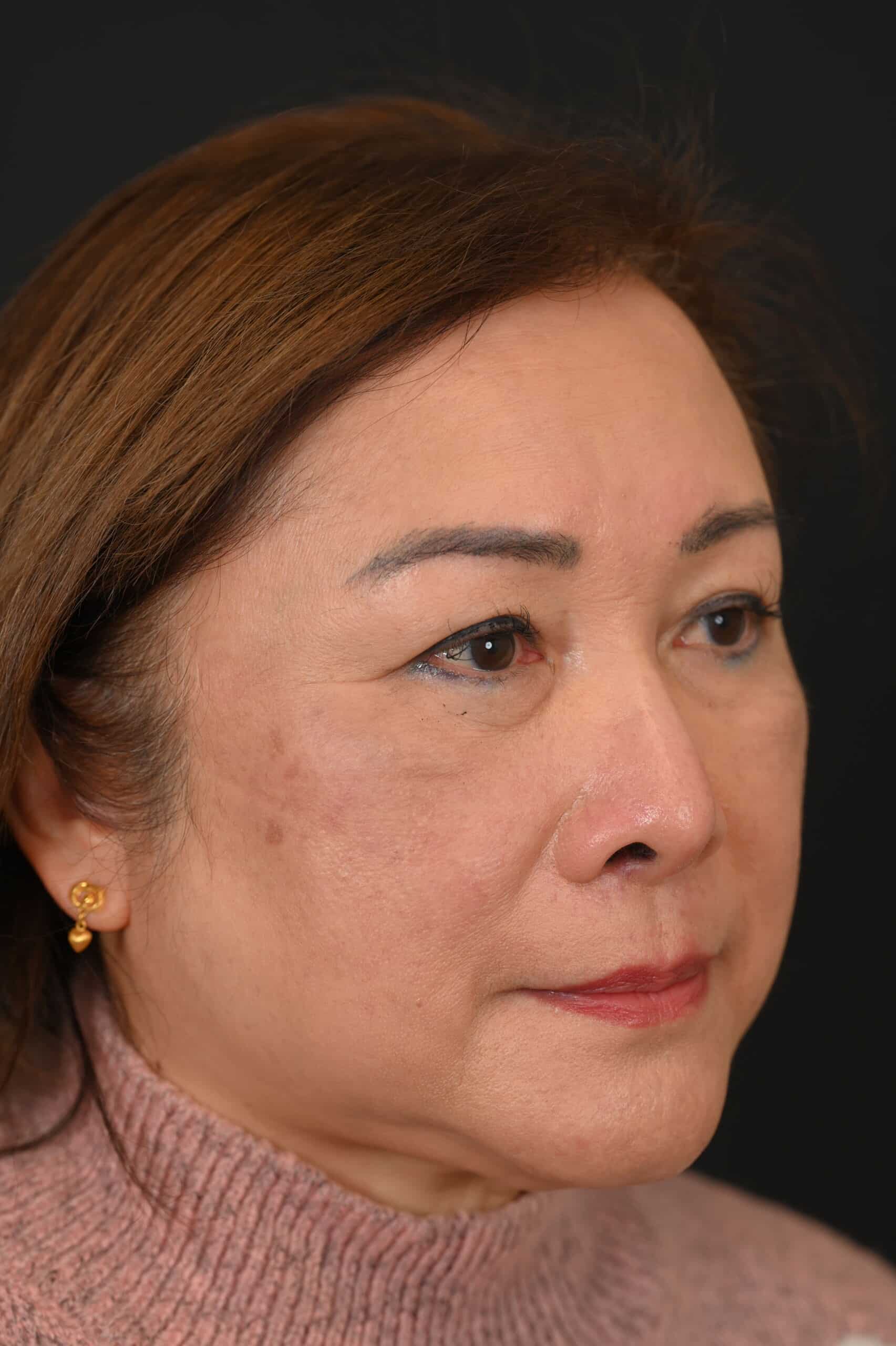 Revision Rhinoplasty