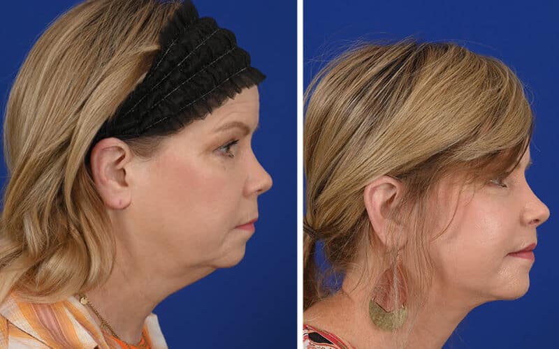 Deep plane facelift before and after