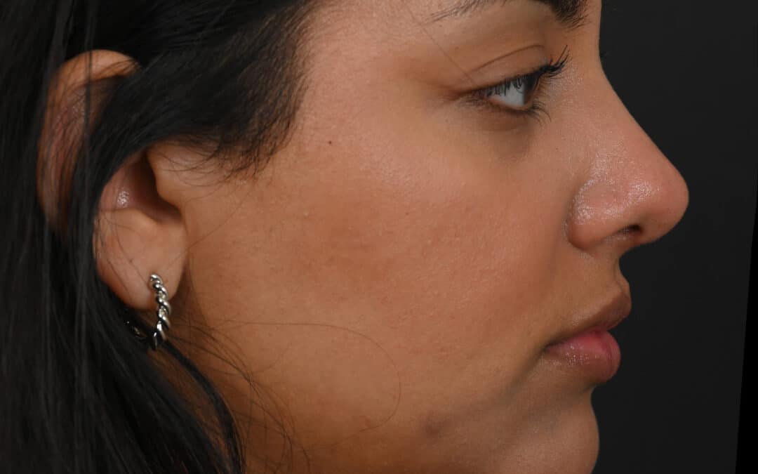 Female Middle Eastern rhinoplasty patient, before and after nose surgery by Houston nose surgeon Dr. Michel Siegel