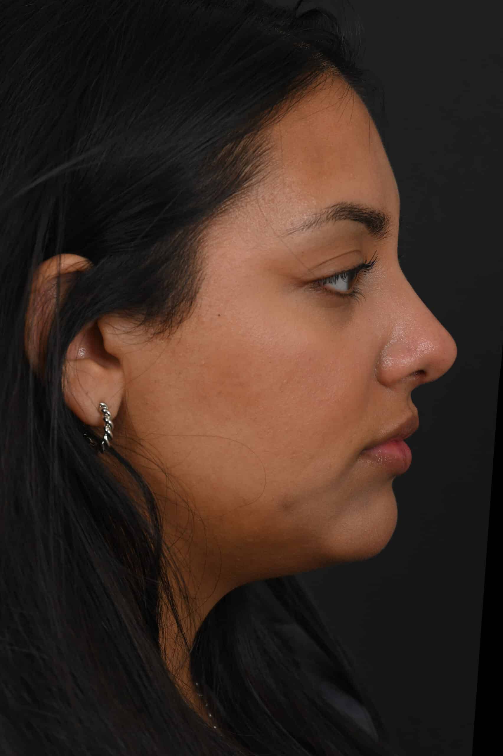 Female Middle Eastern rhinoplasty patient, before and after nose surgery by Houston nose surgeon Dr. Michel Siegel