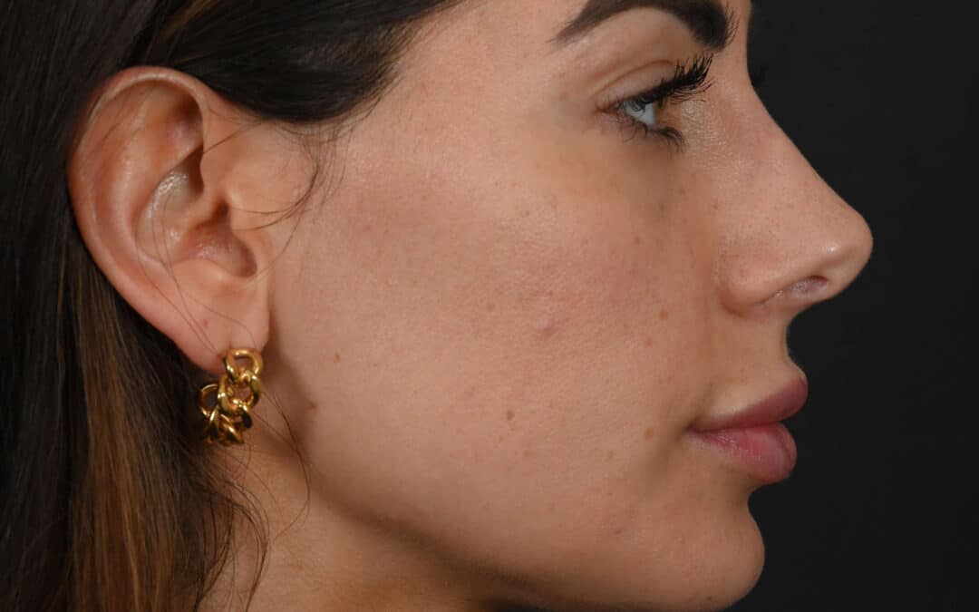 Female Middle Eastern rhinoplasty patient, before and after nose surgery by Houston nose surgeon Dr. Michel Siegel