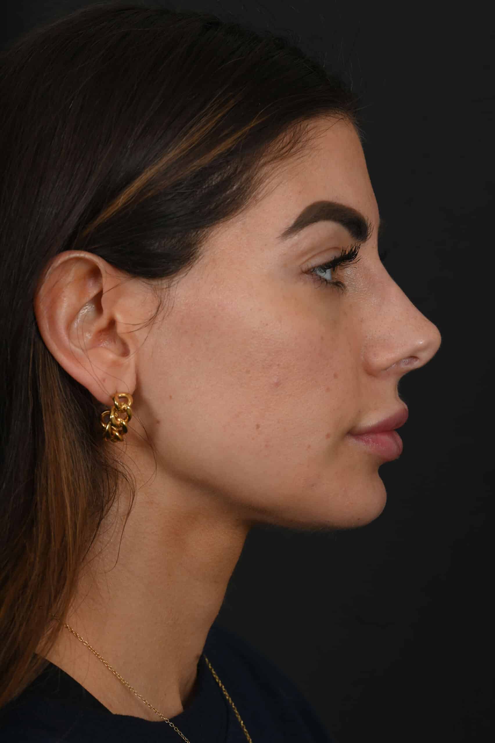 Female Middle Eastern rhinoplasty patient, before and after nose surgery by Houston nose surgeon Dr. Michel Siegel