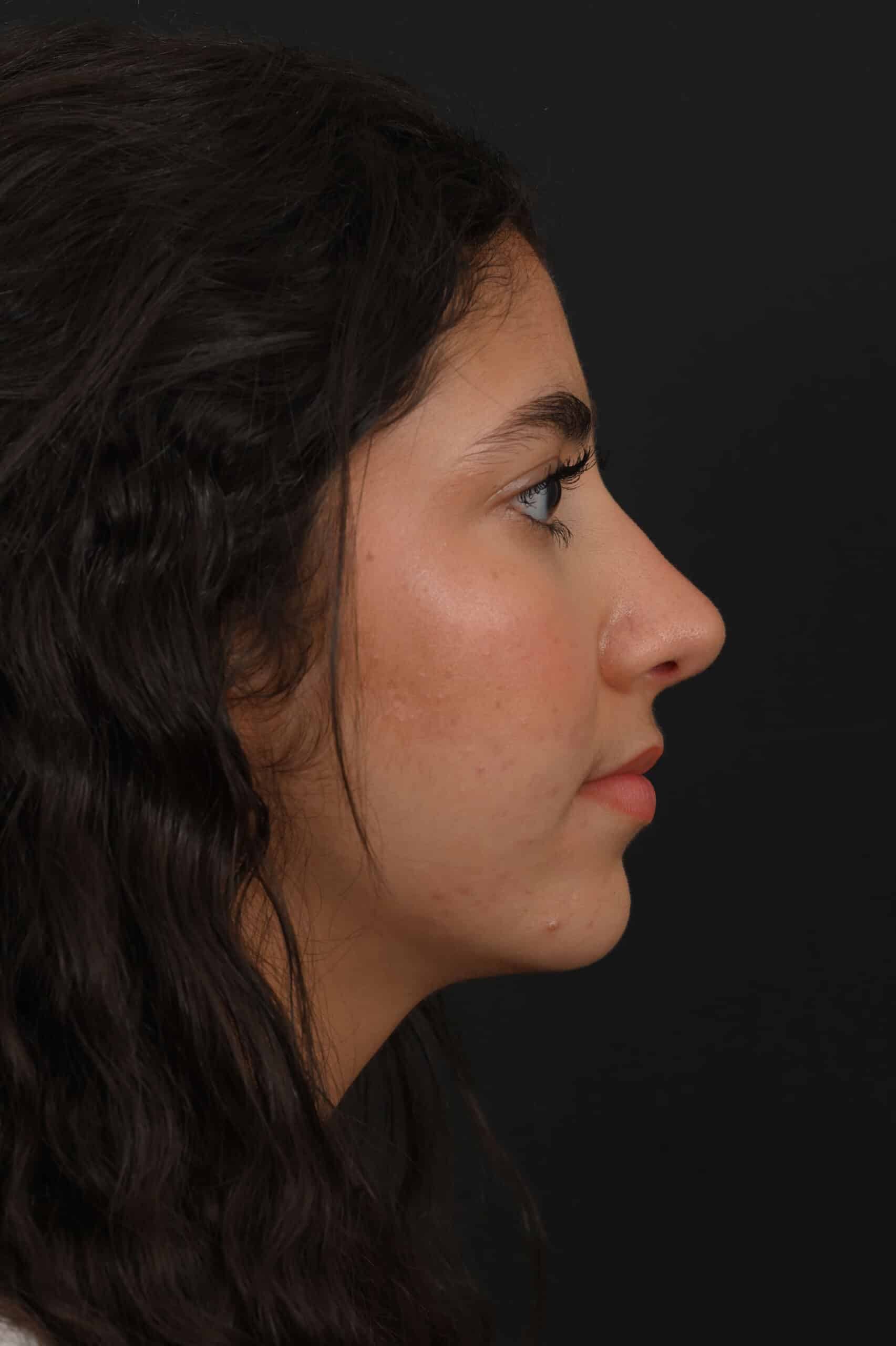 Female Middle Eastern rhinoplasty patient, before and after nose surgery by Houston nose surgeon Dr. Michel Siegel