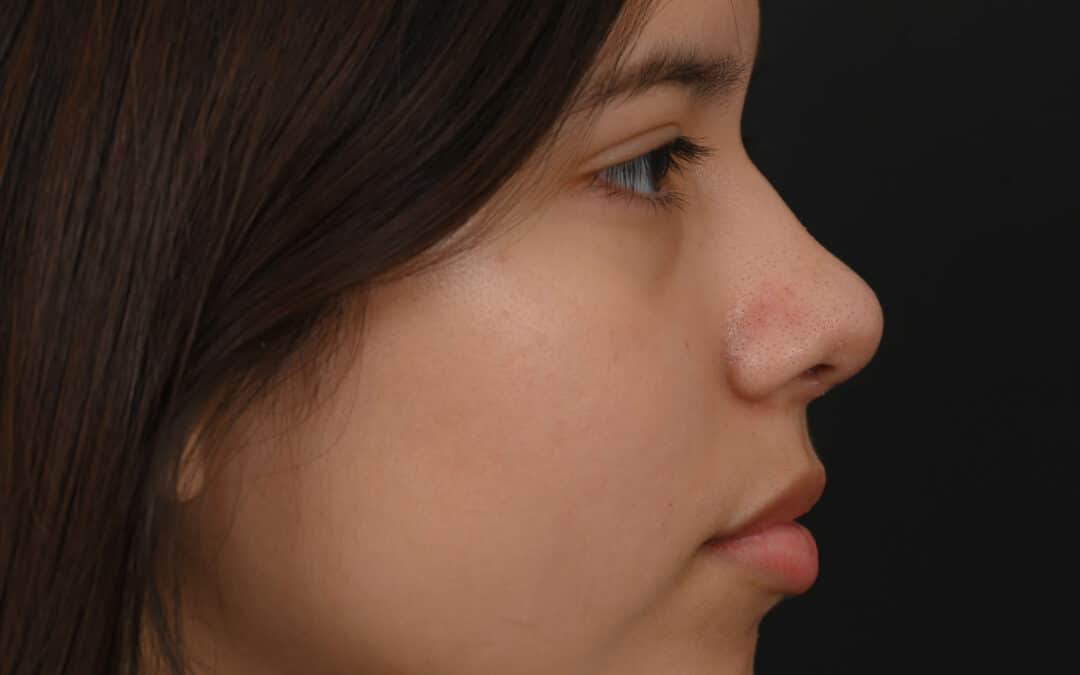 Latina rhinoplasty patient, before and after nose surgery by Houston nose surgeon Dr. Michel Siegel