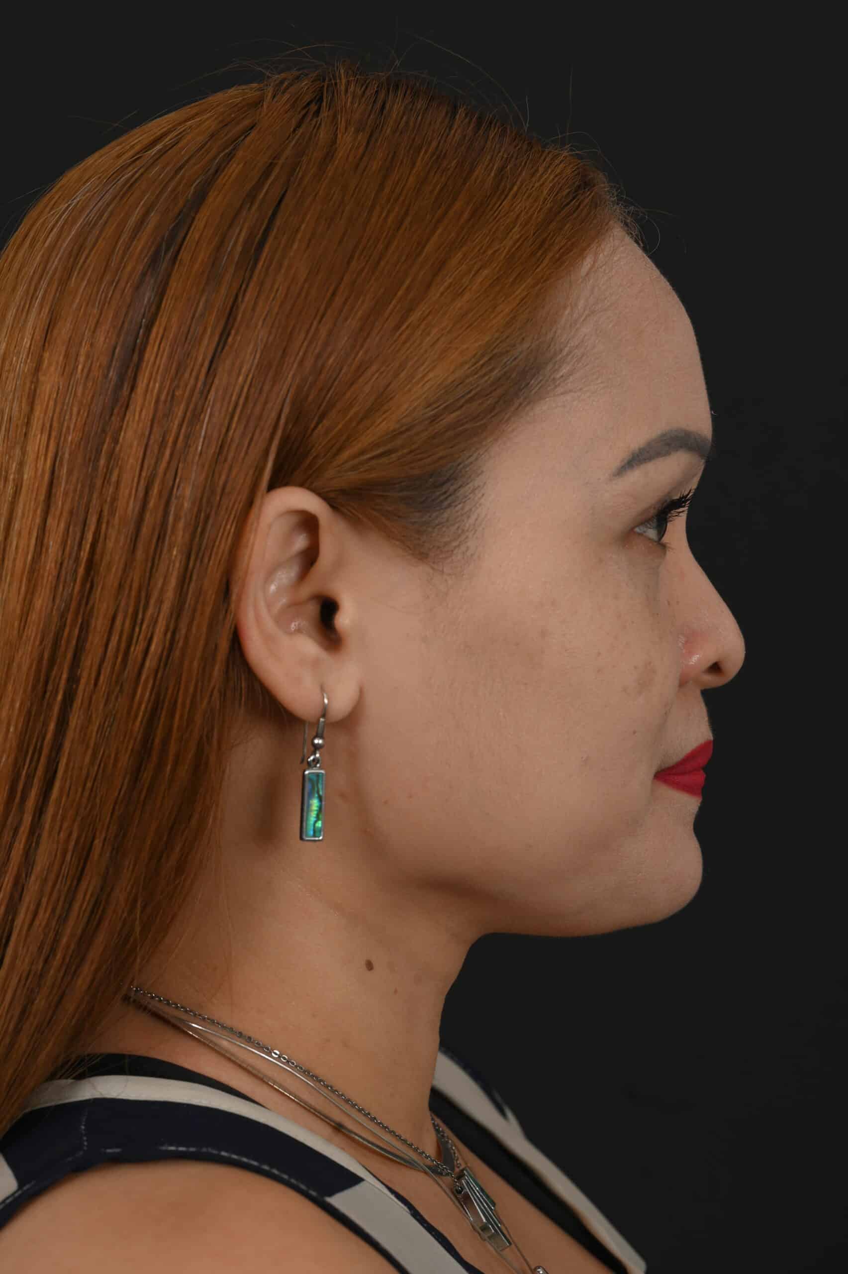 Female Asian rhinoplasty patient, before and after nose surgery by Houston nose surgeon Dr. Michel Siegel