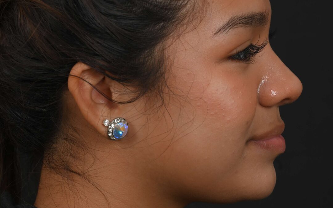 Latina rhinoplasty patient, before and after nose surgery by Houston nose surgeon Dr. Michel Siegel