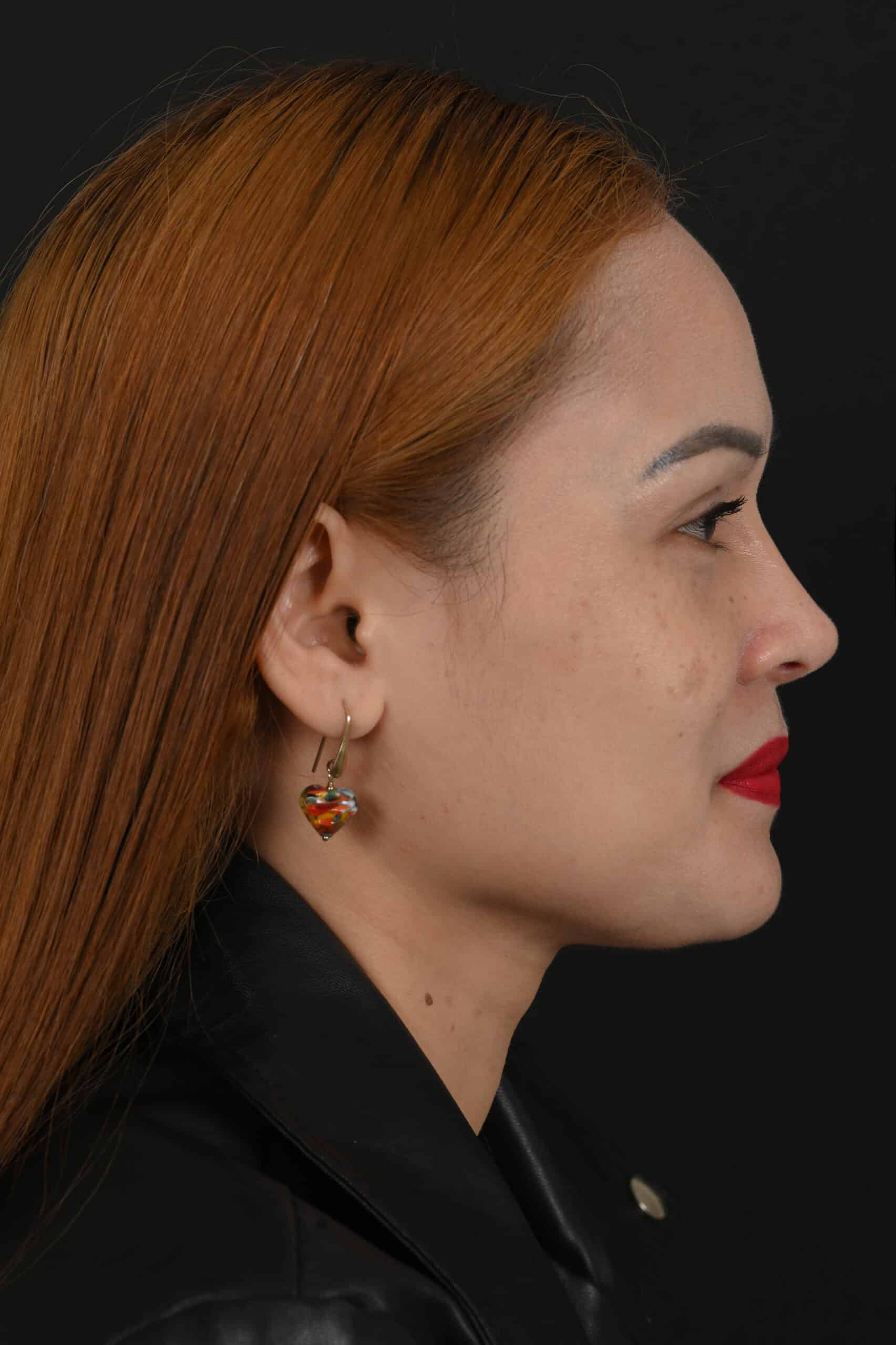 Female Asian rhinoplasty patient, before and after nose surgery by Houston nose surgeon Dr. Michel Siegel