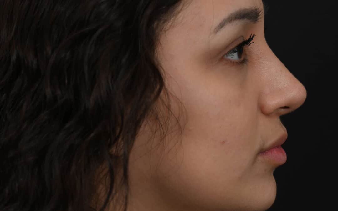 Latina rhinoplasty patient, before and after nose surgery by Houston nose surgeon Dr. Michel Siegel