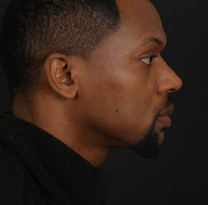 Black male rhinoplasty patient, before and after nose surgery by Houston nose surgeon Dr. Michel Siegel