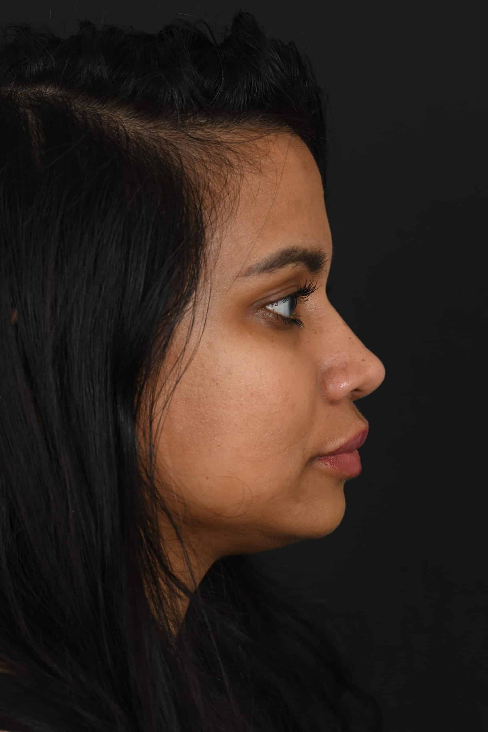 Female Middle Eastern rhinoplasty patient, before and after nose surgery by Houston nose surgeon Dr. Michel Siegel