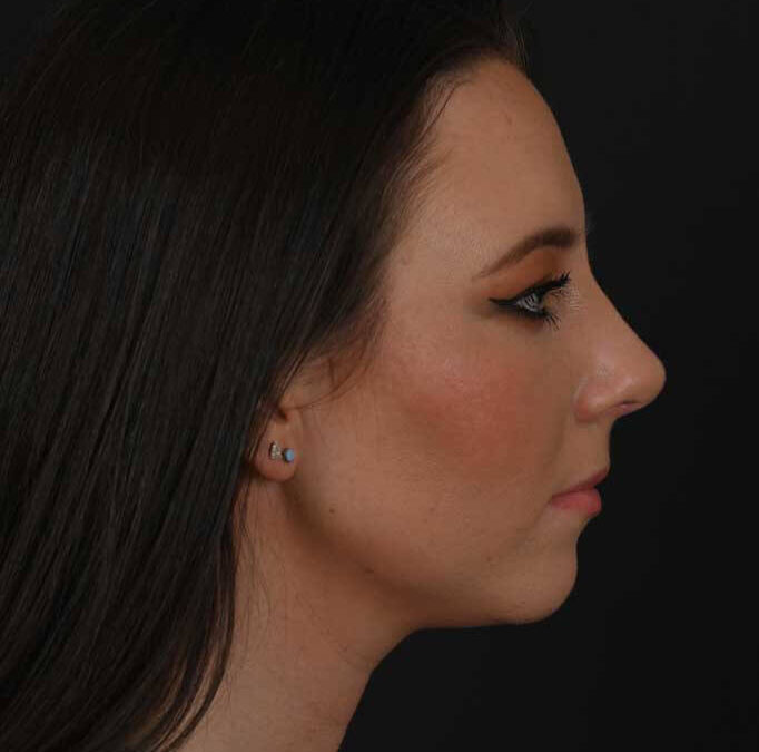 Female white rhinoplasty patient, before and after nose surgery by Houston nose surgeon Dr. Michel Siegel