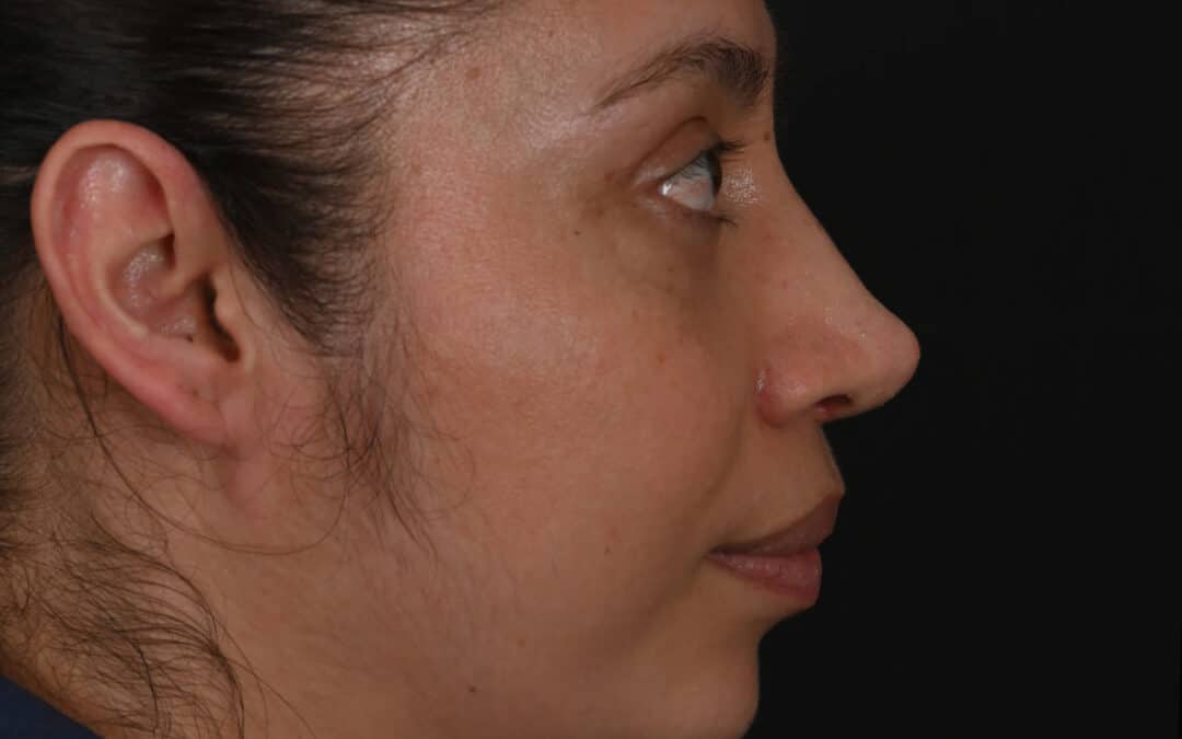 Latina rhinoplasty patient, before and after nose surgery by Houston nose surgeon Dr. Michel Siegel