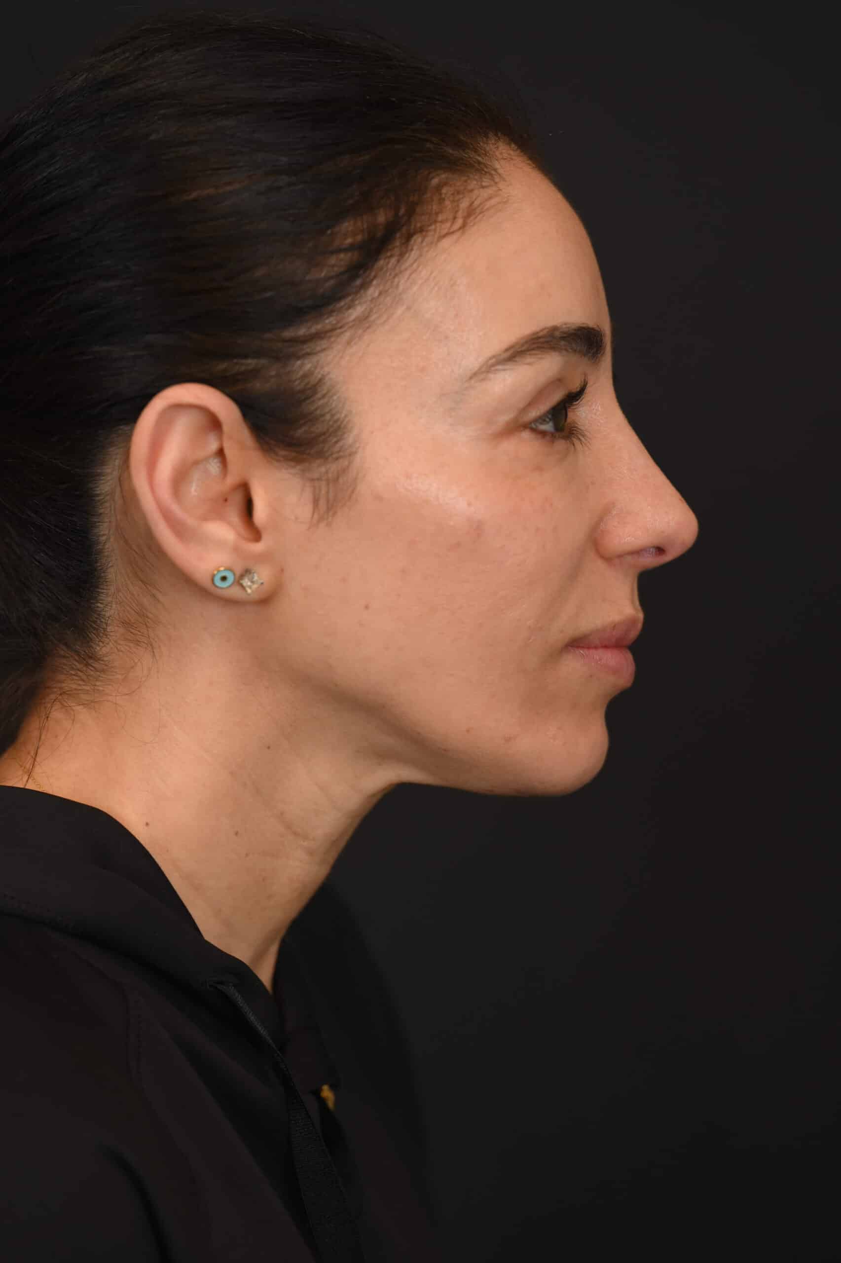 Female Middle Eastern rhinoplasty patient, before and after nose surgery by Houston nose surgeon Dr. Michel Siegel