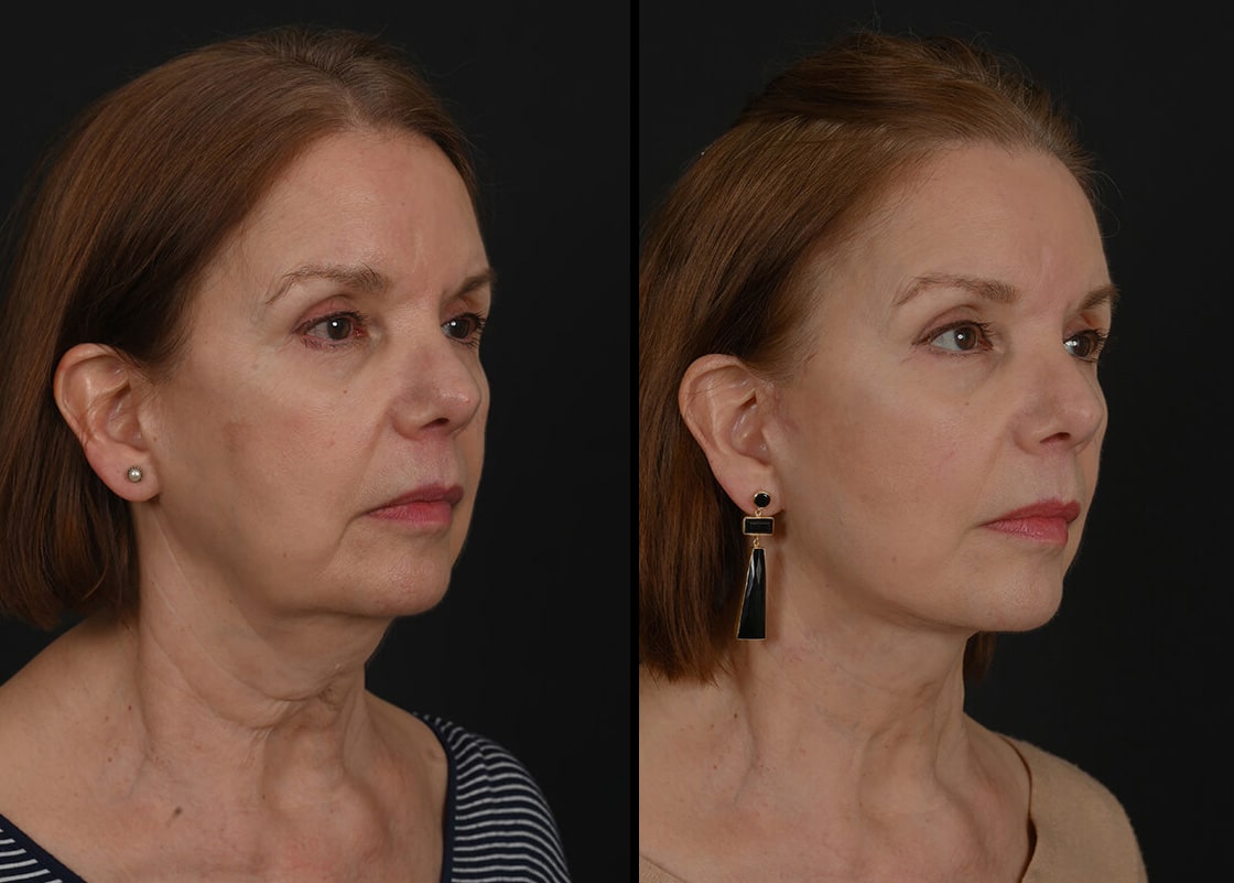 Facelift Before and After
