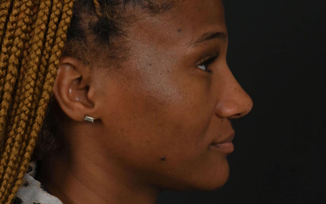 Black female rhinoplasty patient, before and after nose surgery by Houston nose surgeon Dr. Michel Siegel