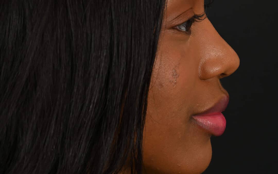Black female rhinoplasty patient, before and after nose surgery by Houston nose surgeon Dr. Michel Siegel