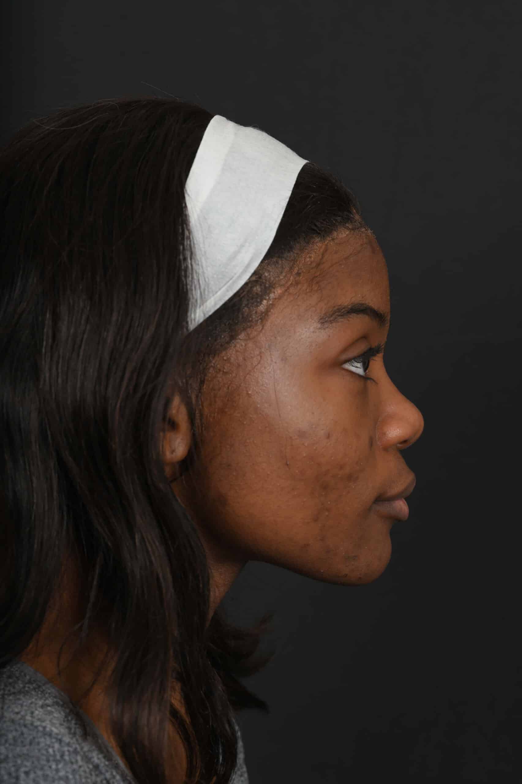 Black female rhinoplasty patient, before nose surgery by Houston nose surgeon Dr. Michel Siegel