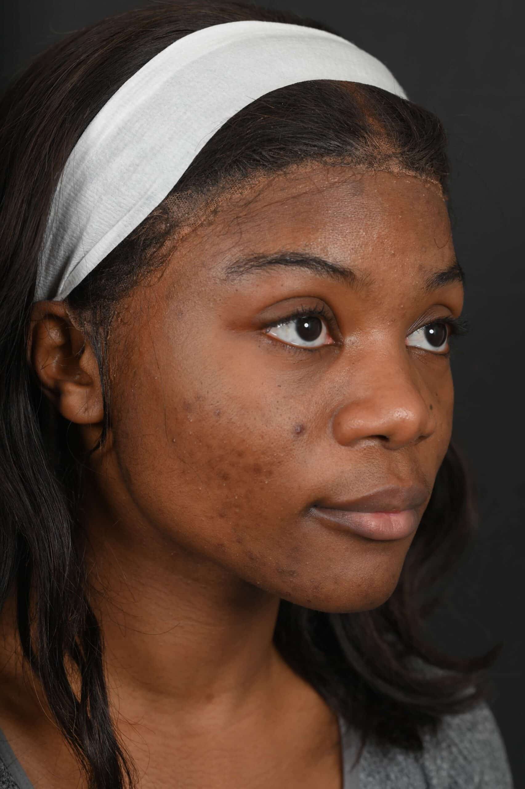 Black female rhinoplasty patient, before nose surgery by Houston nose surgeon Dr. Michel Siegel