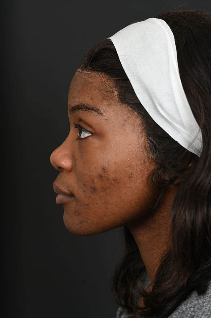 Black female rhinoplasty patient, before nose surgery by Houston nose surgeon Dr. Michel Siegel