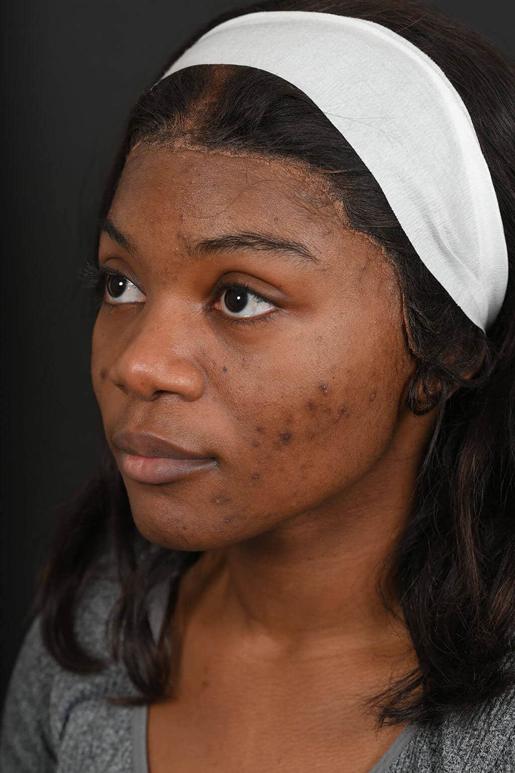 Black female rhinoplasty patient, before nose surgery by Houston nose surgeon Dr. Michel Siegel