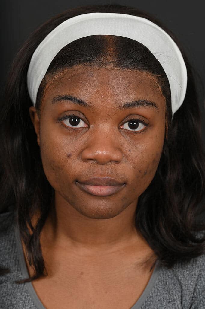 Black female rhinoplasty patient, before nose surgery by Houston nose surgeon Dr. Michel Siegel