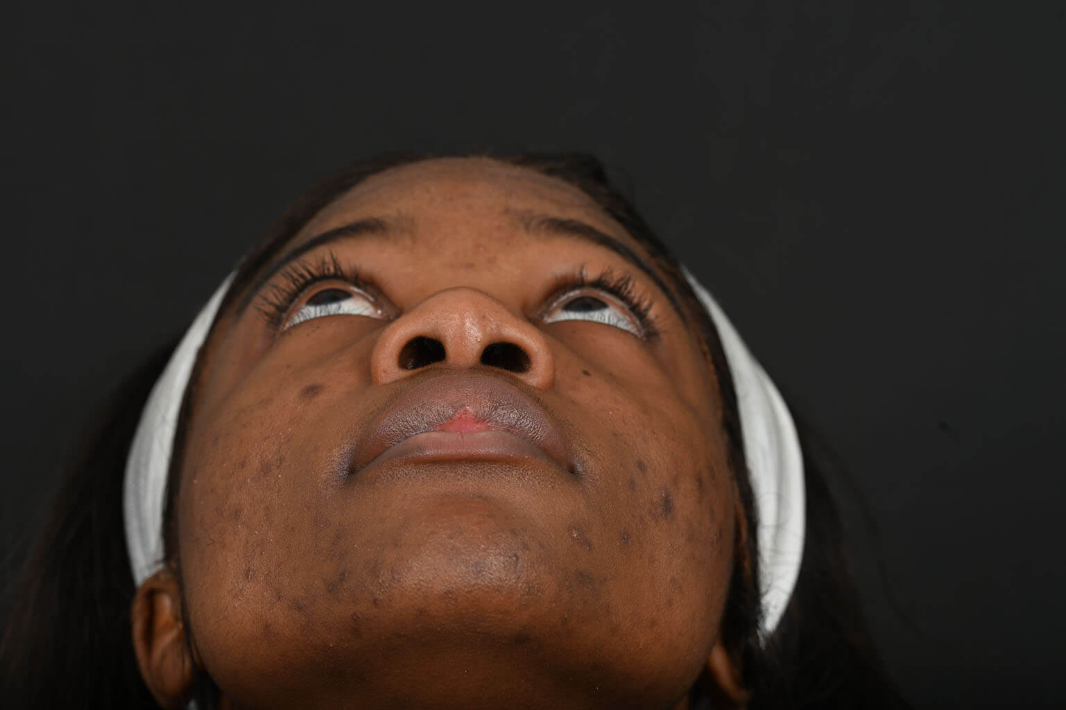 Black female rhinoplasty patient, before nose surgery by Houston nose surgeon Dr. Michel Siegel