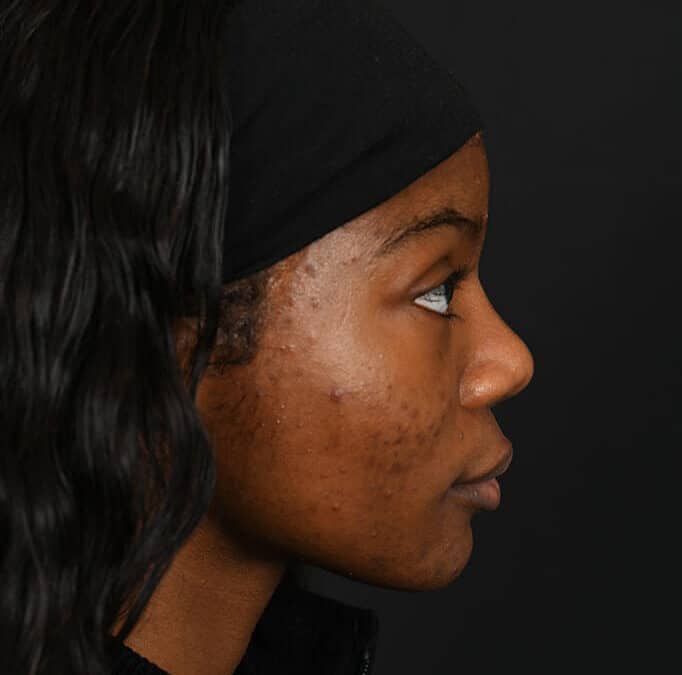 Black female rhinoplasty patient, before and after nose surgery by Houston nose surgeon Dr. Michel Siegel