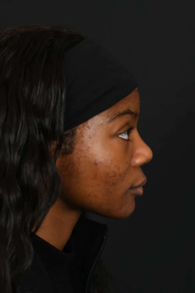Black female rhinoplasty patient, before and after nose surgery by Houston nose surgeon Dr. Michel Siegel