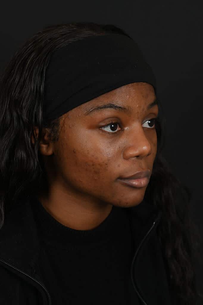 Black female rhinoplasty patient, after nose surgery by Houston nose surgeon Dr. Michel Siegel