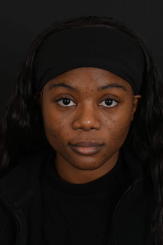 Black female rhinoplasty patient, after nose surgery by Houston nose surgeon Dr. Michel Siegel