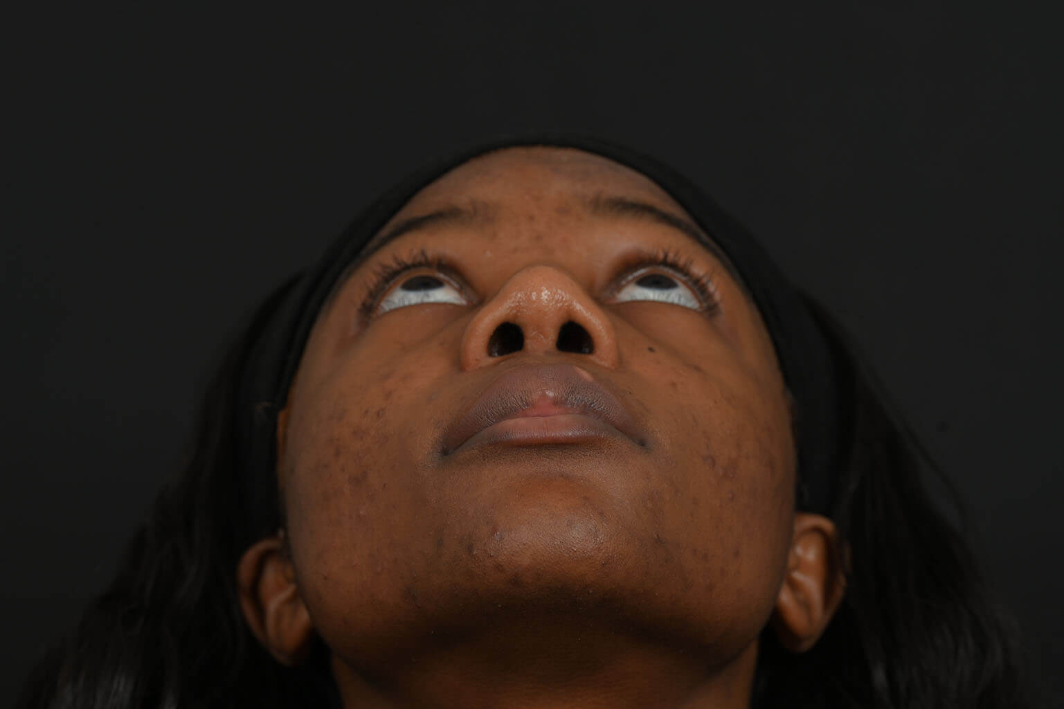 Black female rhinoplasty patient, after nose surgery by Houston nose surgeon Dr. Michel Siegel